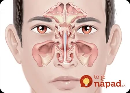 Našli sme najjednoduchší spôsob, ako sa zbaviť infekcie prínosových dutín. Všetko, čo potrebujete, je tento starý trik