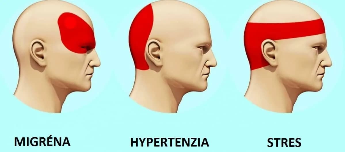 Takto sa zbavíte bolesti hlavy za 5 minút: Bez tabletiek a bez toho, aby ste niekam chodili
