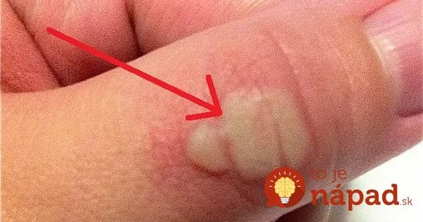 Trik starej mamy, ako si poradiť s popáleninou raz-dva: Stačí vám len vec, ktorú máte po ruke!