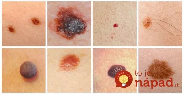 Naučte sa, ako rozpoznať rakovinu kože a ako jej predísť!