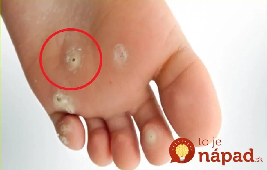 Kurieho oka vás pomôže zbaviť burina, ktorej sa všetci vyhýbame oblúkom