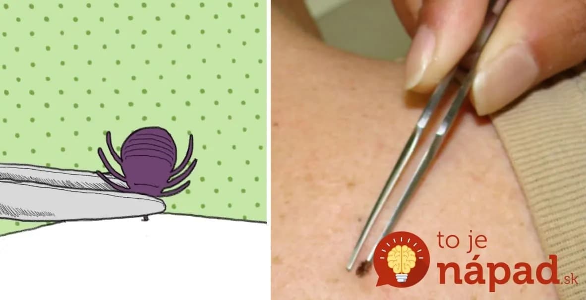 Na toto dávajte pozor: 4 veci, ktoré nesmiete NIKDY urobiť, keď si nájdete kliešťa!