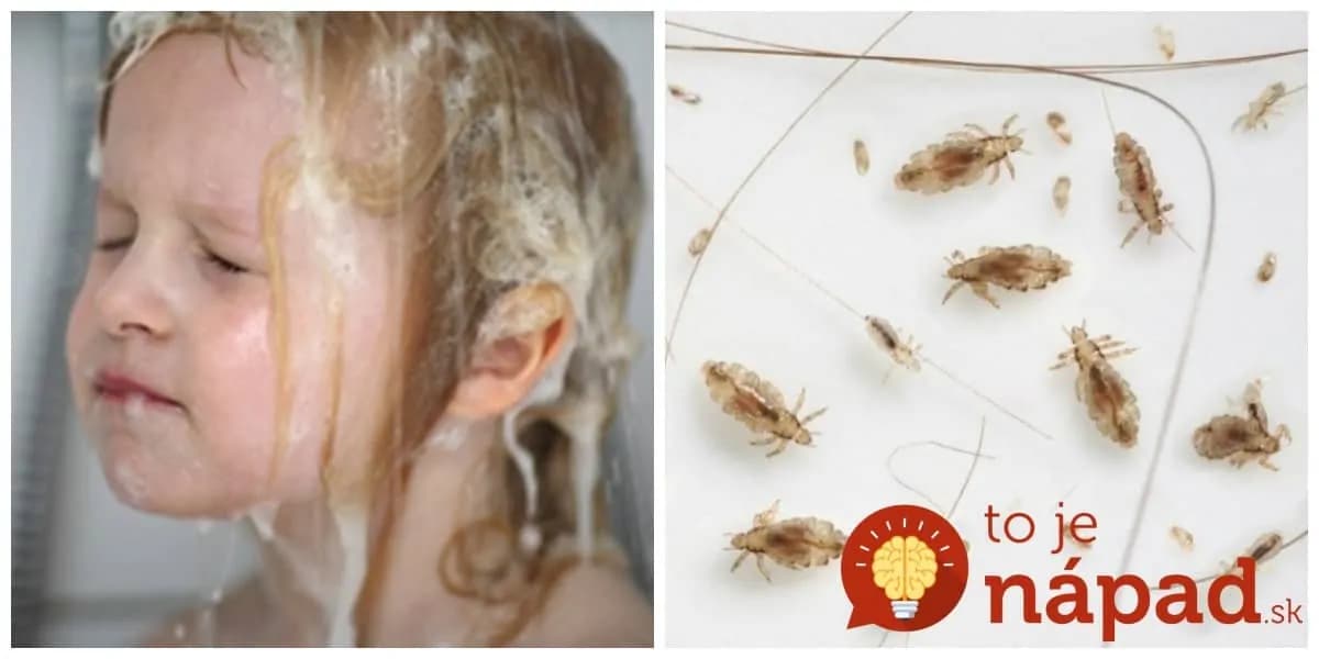 Drahé šampóny proti všiam ma sklamali na plnej čiare: Tento geniálny nápad za pár centov ich zlikvidoval u dcérky dokonale a to ich mala plnú hlávku!