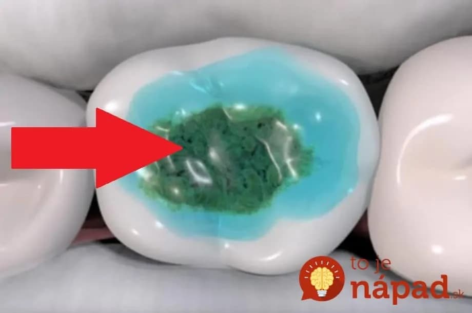 Netreba vŕtať! Takto sa dá vyliečiť zubný kaz!