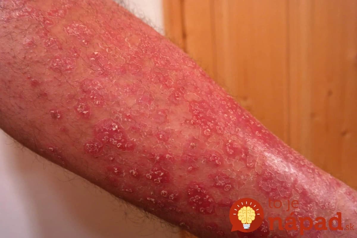 Zabudnite na drahé prípravky z lekárne. Tento zázrak pomôže ľuďom s psoriázou a ekzémami, na ktoré už nič nezaberá