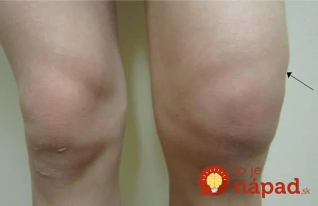 Recept, ktorý zaberá na zápal, bolesť aj opuch kĺbov najrýchlejšie: Odskúšané, funguje!