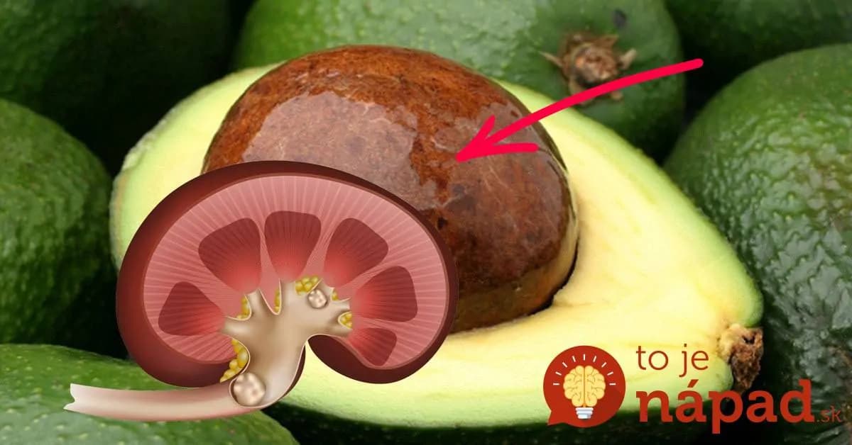 Keď budete mať doma drahé avokádo, kôstku určite nevyhadzujete: O týchto možnostiach ako ju využiť sa vám ani nesnívalo!