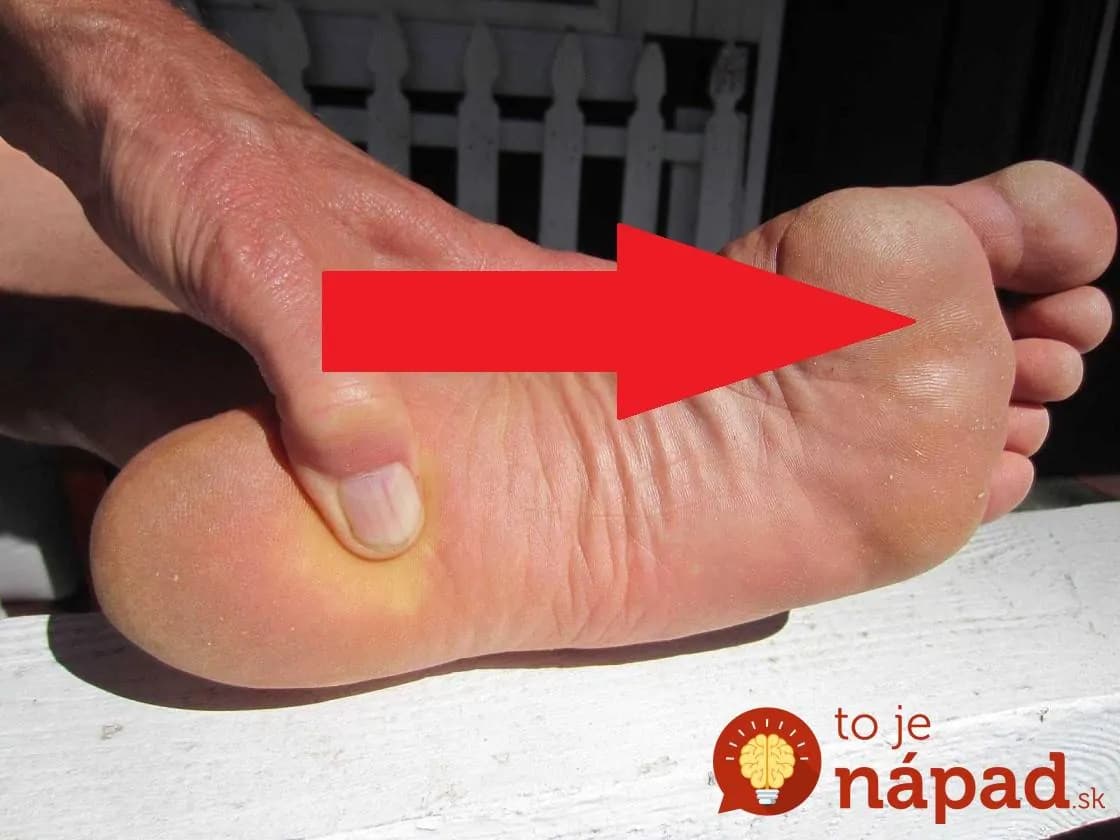 Konečne vec, ktorá funguje na kurie oká zaručene a hlavne rýchlo: Takto sa ich zbaví aj ten, komu nezaberá lastovičník!