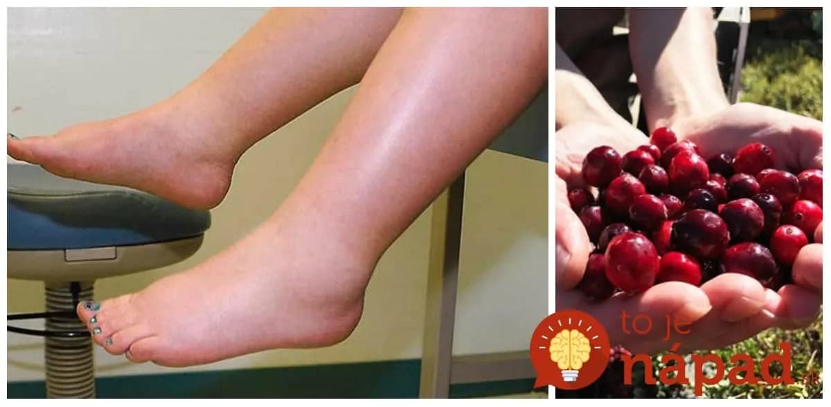 Zbohom opuchnuté nohy a kilá navyše: 9 potravín, ktoré zbavia vaše telo zadržanej vody!