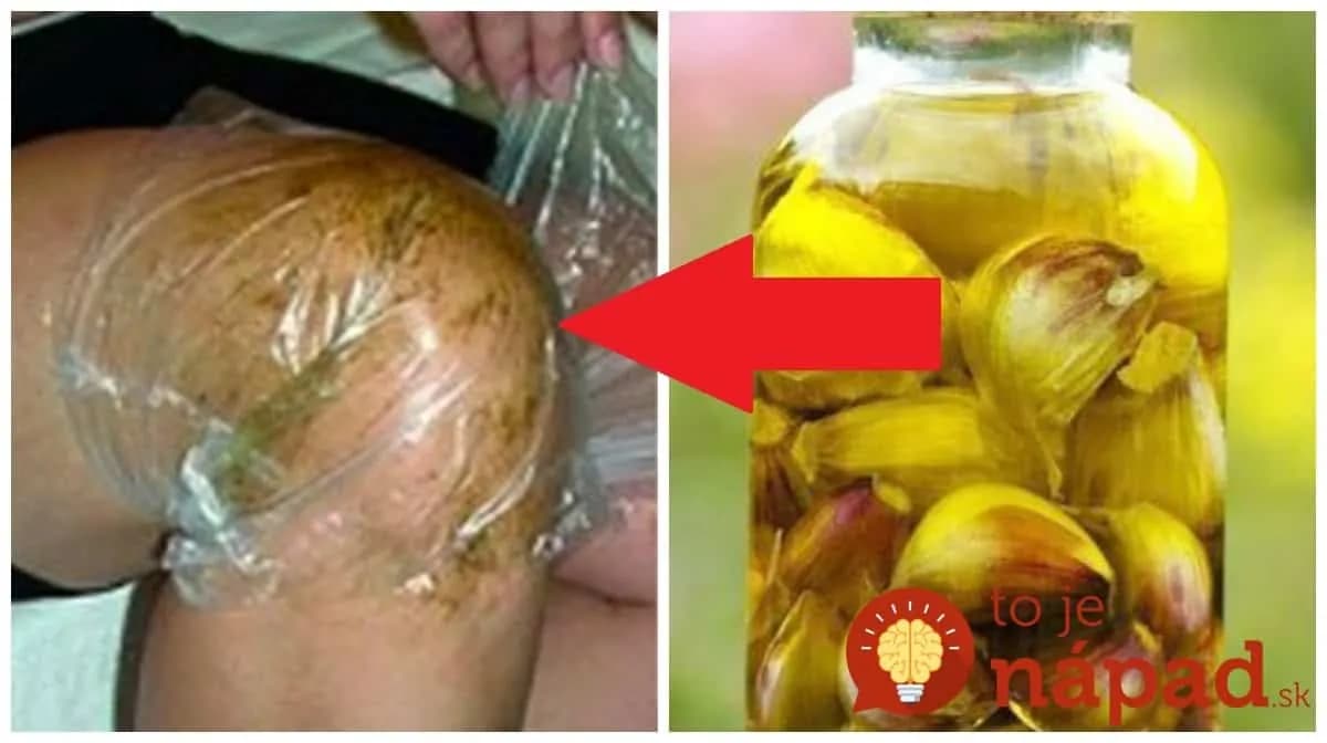 Aj keď bolo s kĺbmi najhoršie, zabralo to vždy: Stačí len natrieť a ísť spať – pre mňa najväčšia pomoc na boľavé kolená!