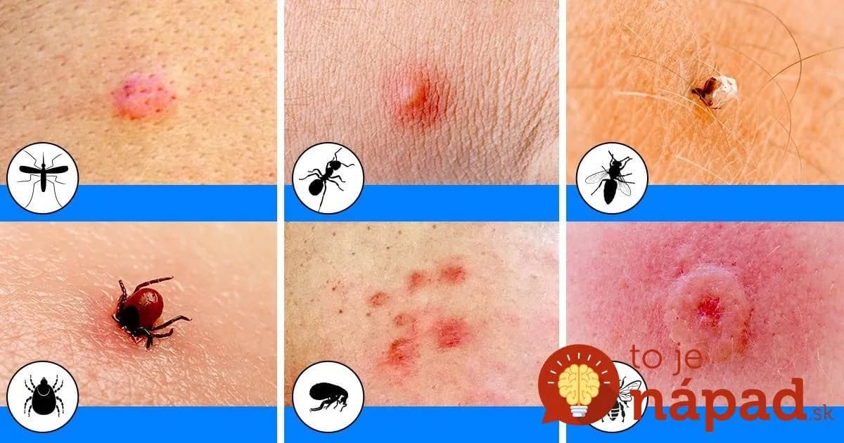 9 druhov štípancov, ktoré by mal rozpoznať každý: Podľa tohoto jasne spoznáte aj nebezpečnú plošticu!