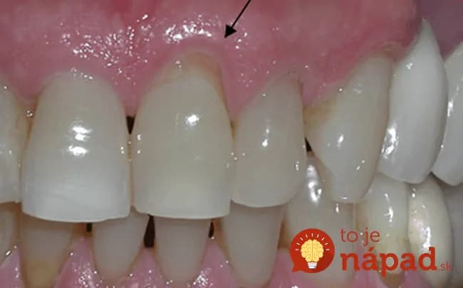Ako liečiť ustupujúce a boľavé ďasná? Toto mi pomohlo skoro hneď, na ten účinok nemá ani drahá zubná pasta!