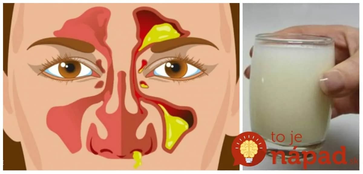 Zbohom suchý kašeľ, škriabanie v hrdle a upchatý nos: Tento sirup volám z večera do rána – večer užijete a ráno ste ako rybička!