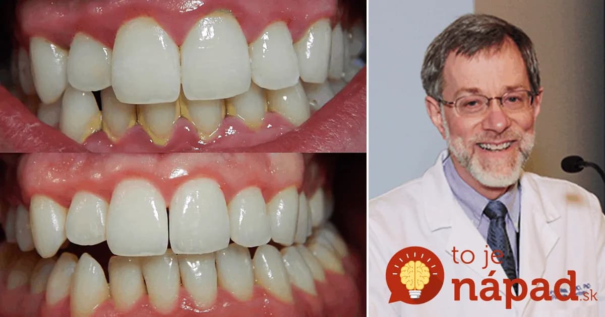 Najlepšia domáca metóda na odstránenie zubného kameňa: Naučil ma to zubár!