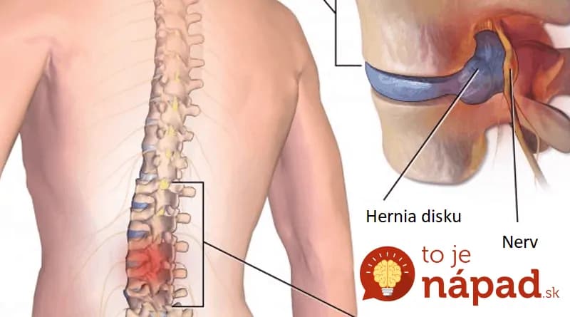 Chirurg ukázal najjednoduchší spôsob, ako pomôcť chrbtici – a zabralo to: Keby to vedel každý, bolo by oveľa menej operácií!