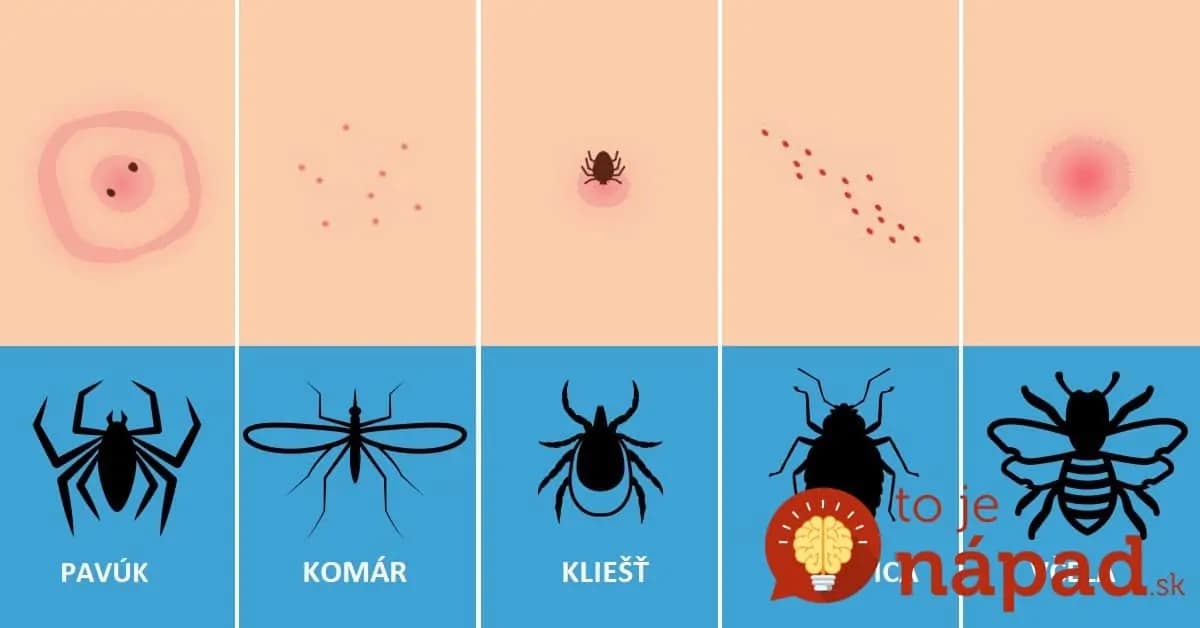 10 uštipnutí hmyzom a čo robiť pri každom jednom z nich: Toto využije počas CELÉHO ROKA!