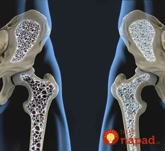 7 vecí ktoré posilnia vaše kosti: Osteoporóza nemá šancu!