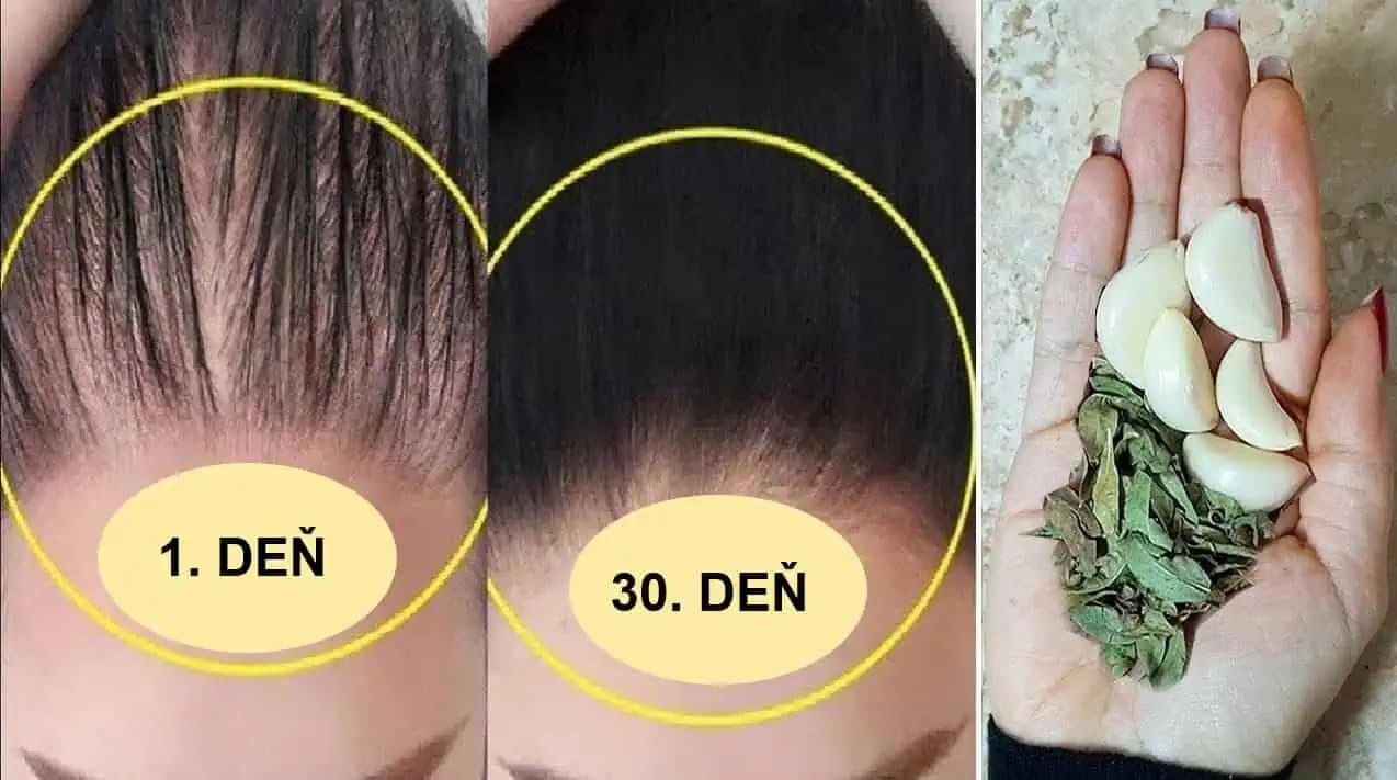Vďaka tejto kúre sa zbavíte problému s vypadávaním vlasov: Fantastické výsledky už po 30 dňoch!