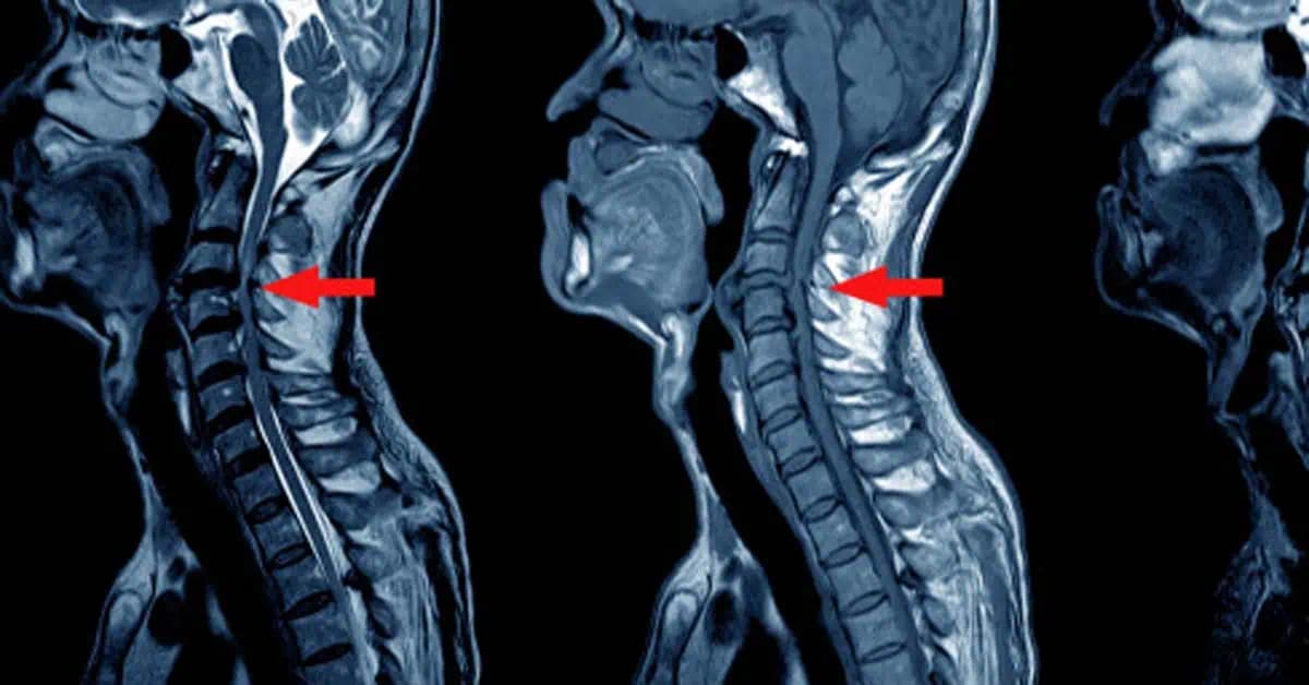 Tieto cviky dajú do poriadku vašu krčnú chrbticu: Zbierka tých najlepších, ktoré prinesú rýchlu úľavu od bolesti!