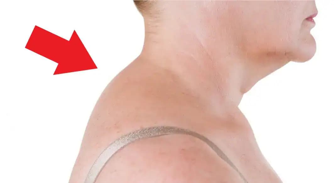 Lekár ukázal 4-minútové cvičenie, ktoré ODSTRÁNI „hrb“ na krku a napraví držanie tela: Zmenu vidíte už o 14 dní!