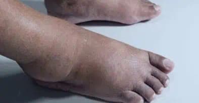 STOP opuchnutým nohám: Jednoduché a efektívne domáce postupy, ktoré vás zbavia opuchu, aj bolesti!