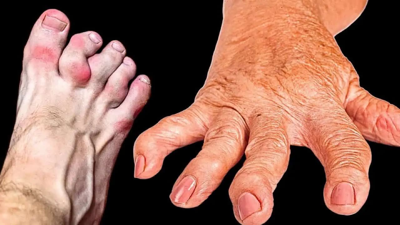 Trápi vás artritída a bolesti kĺbov? NIKDY nejedzte týchto 7 potravín! Dôvod by mal poznať úplne každý!