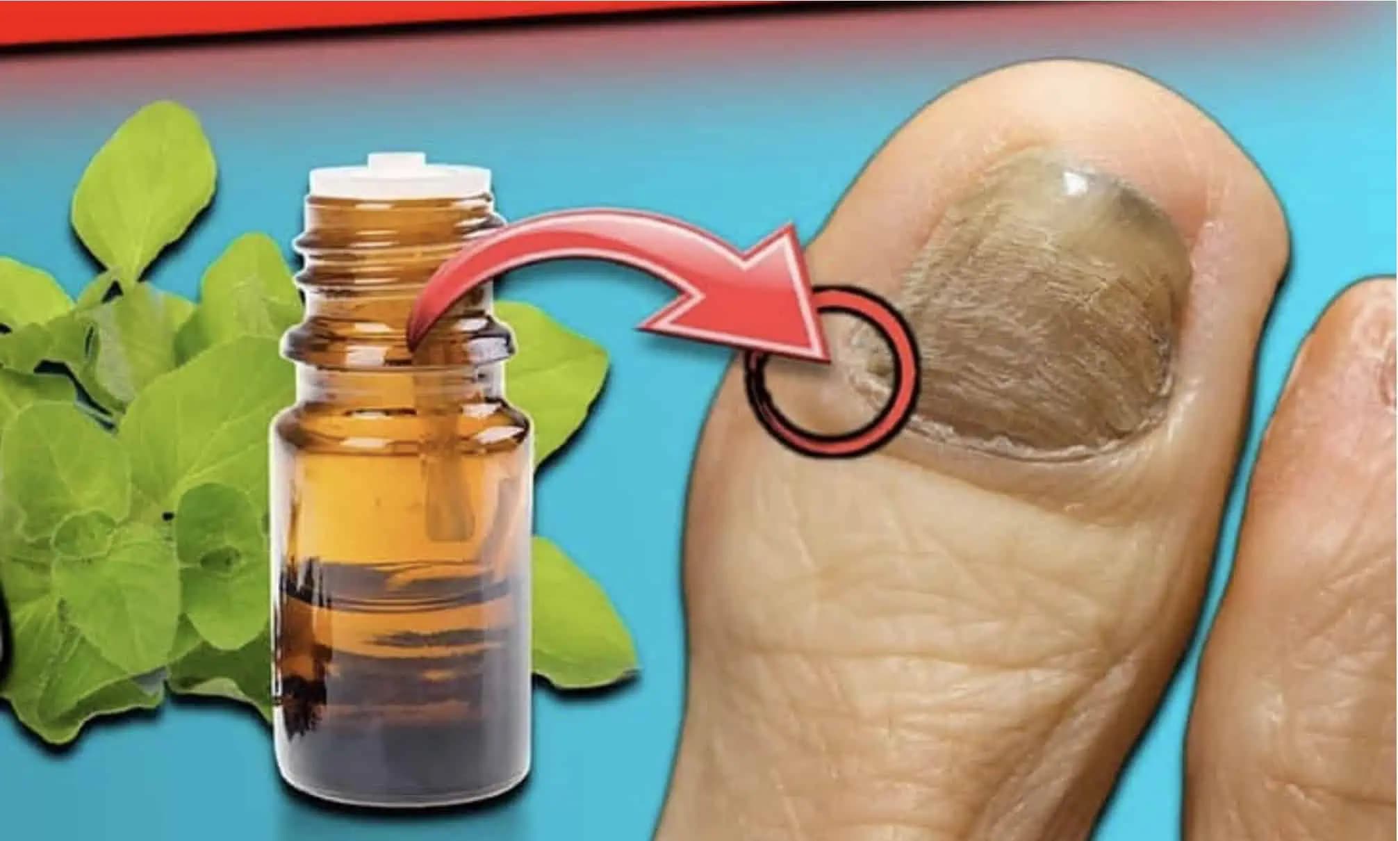 Zbavte sa PLESNE na nechtoch za 1 DEŇ! Toto je najsilnejšia prírodná zbraň proti plesni na nechtoch!