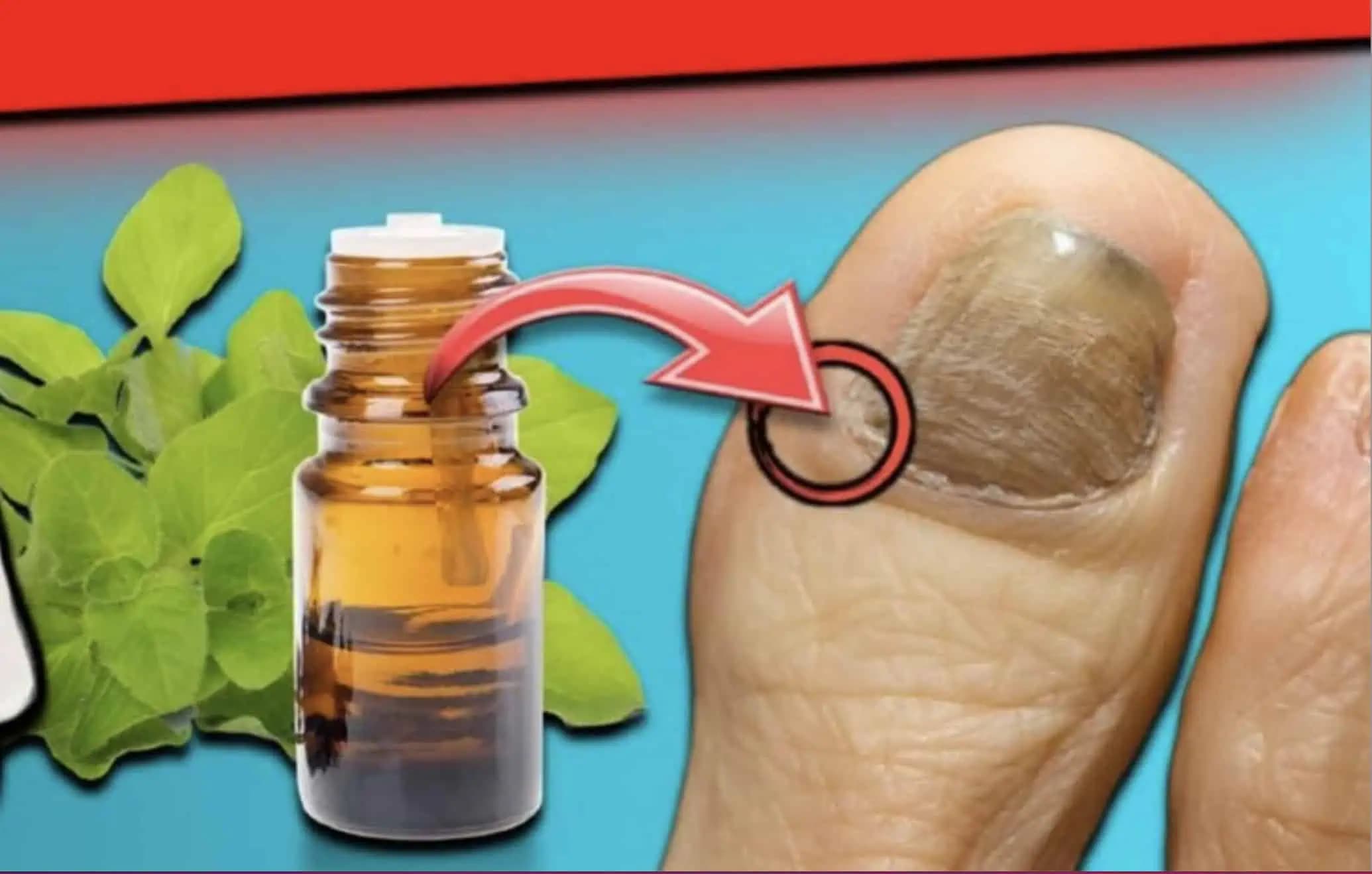 Pleseň na nechtoch a infekcia ZMIZNE za 24 hodín: Kiežby som o tom vedela skôr!