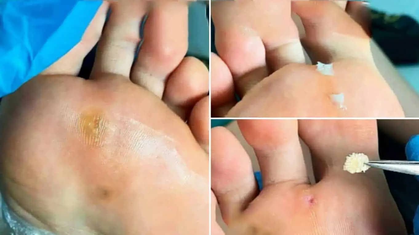 Zbaviť BRADAVÍC a kurieho oka sa dá rýchlo aj bez návštevy lekára: Odskúšaná prírodná metóda!