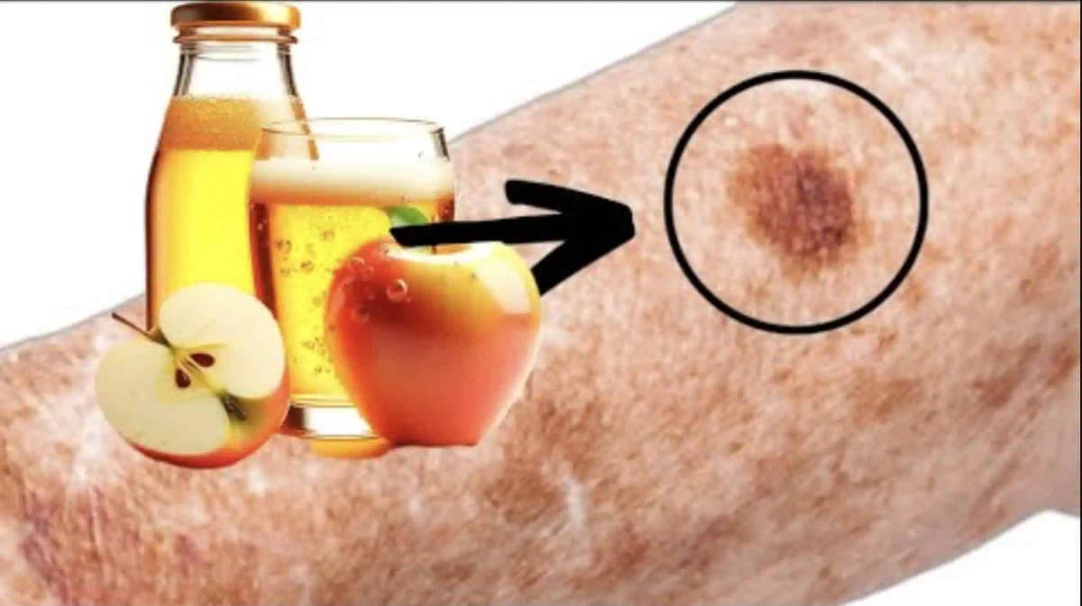 TRIK, ako sa NATRVALO zbaviť pigmetnových škvŕn pomocou obyčajného octu: Funguje to!