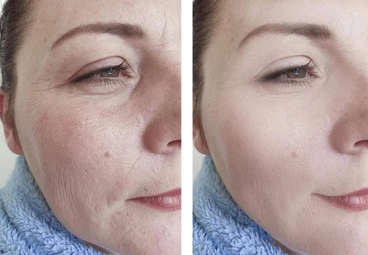 Ženy, chcete BOTOX bez ihiel? Vezmite 2 Eurá a choďte do lekárne, tento lacný produkt robí zázraky!