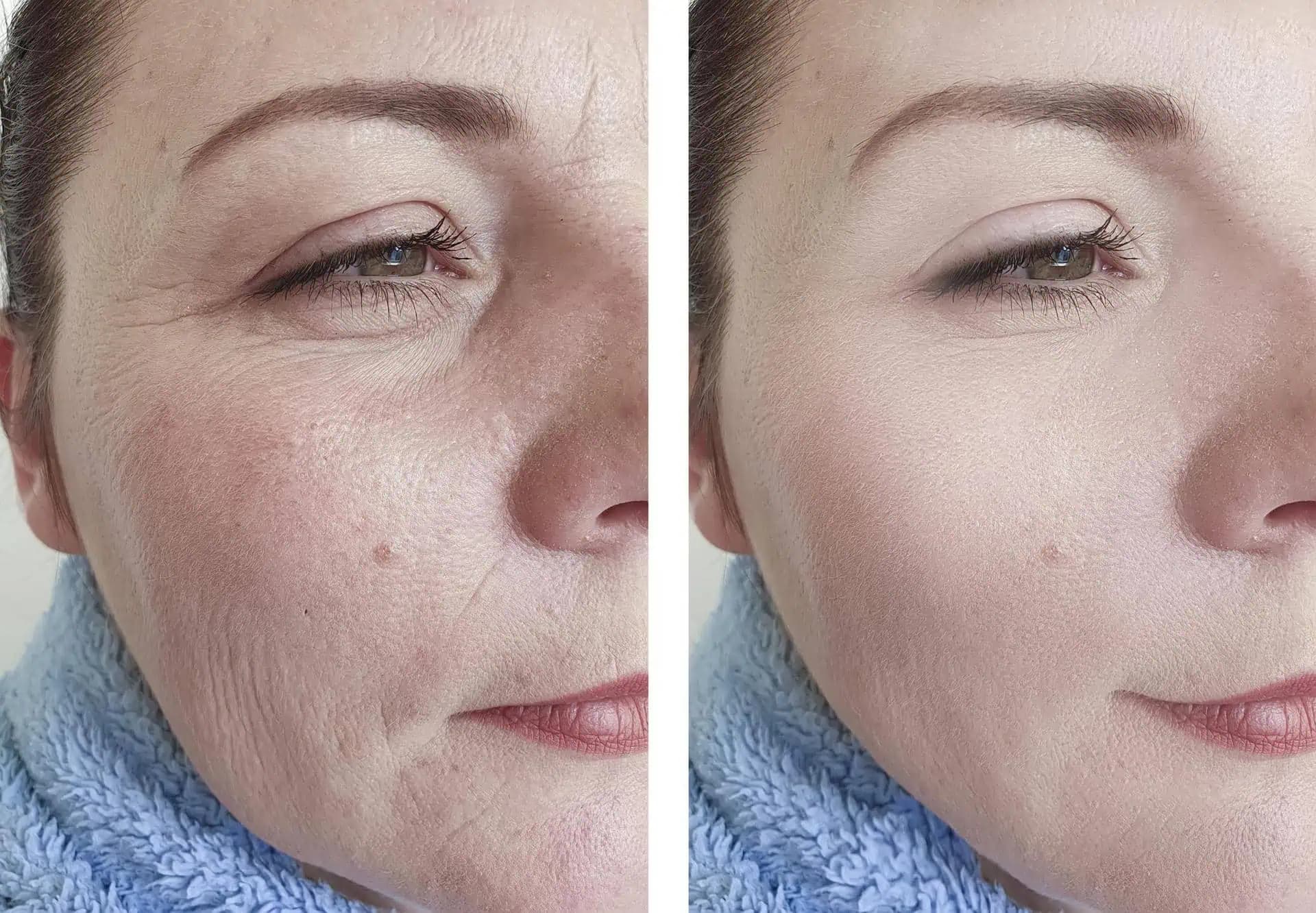 Ženy, chcete BOTOX bez ihiel? Vezmite 2 Eurá a choďte do lekárne, tento lacný produkt robí zázraky!