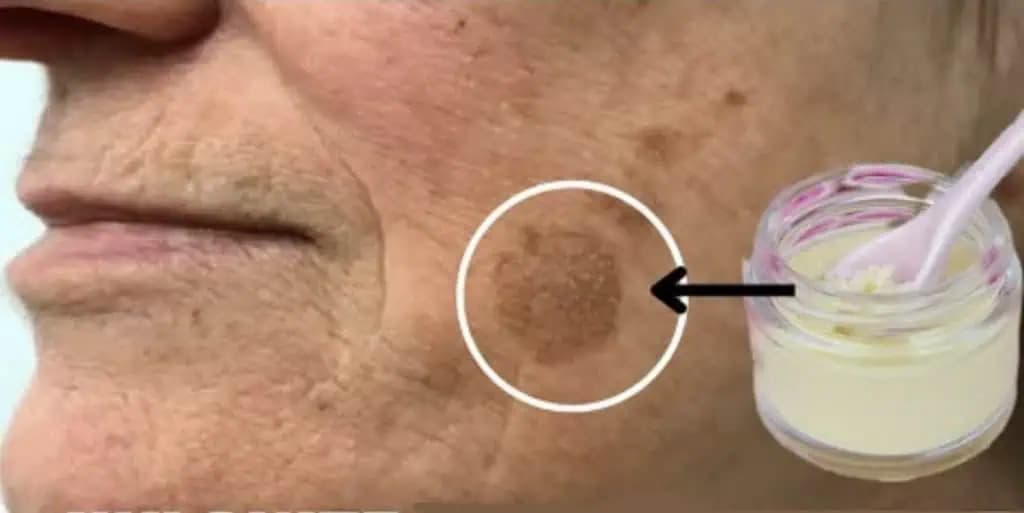 Ako sa zbaviť tmavých škvŕn CEZ NOC? Toto len zamiešajte, naneste na tvár a do rána sú preč!