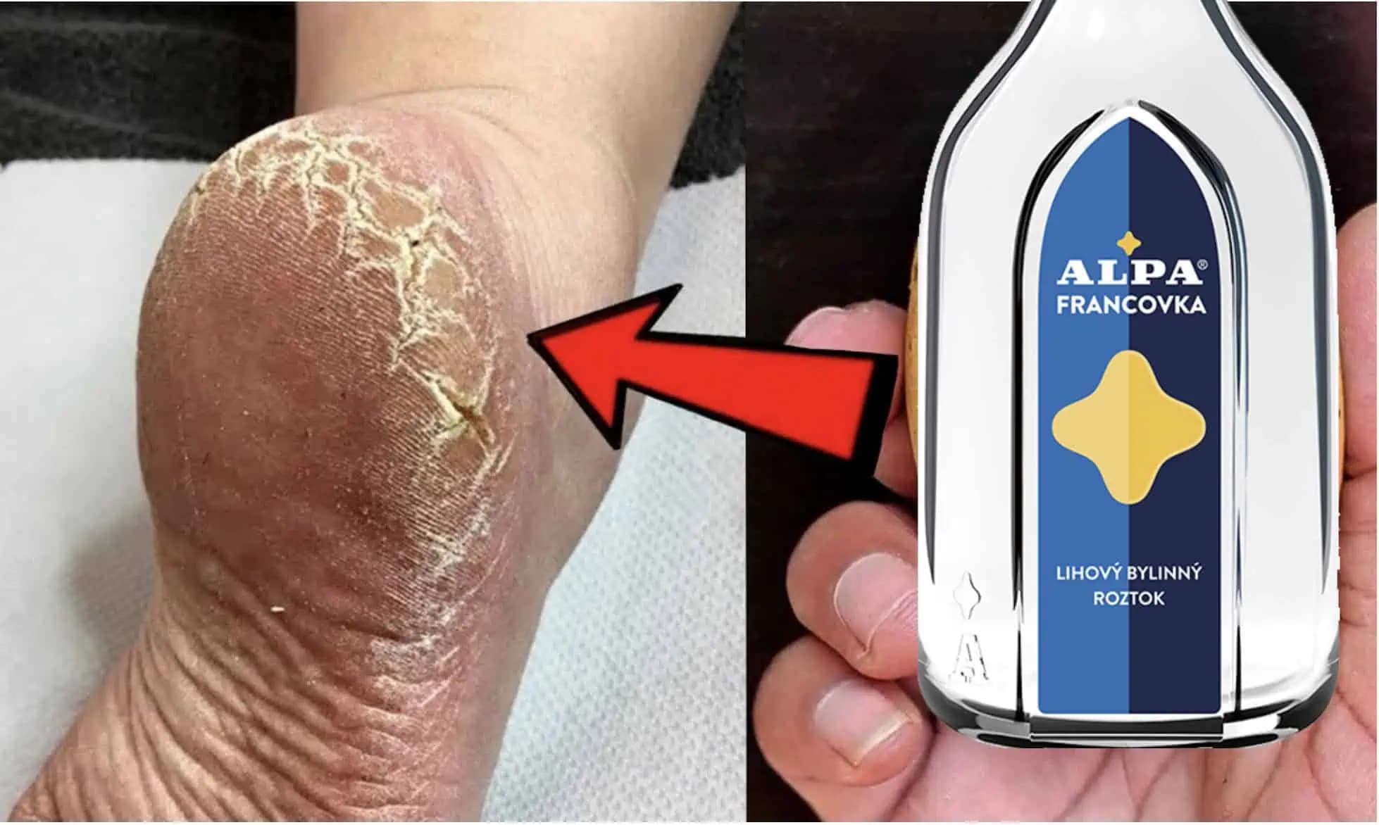 Stačí pár dní a máte nohy ako bábätko: Stvrdnutú kožu a otlaky na nohách už neriešim, toto funguje či je leto alebo zima!