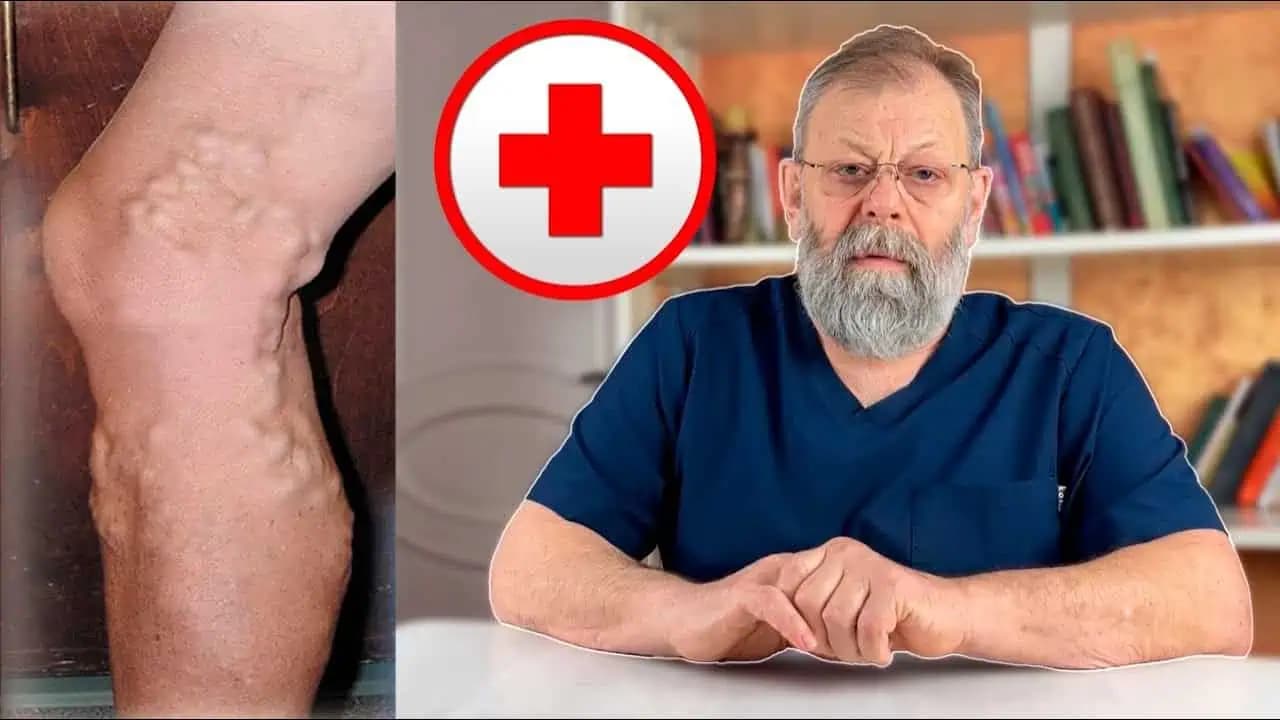 Kŕčové žily sa dajú odstrániť aj bez operácie: Lekár ukázal 5 cvikov za 7 minút!