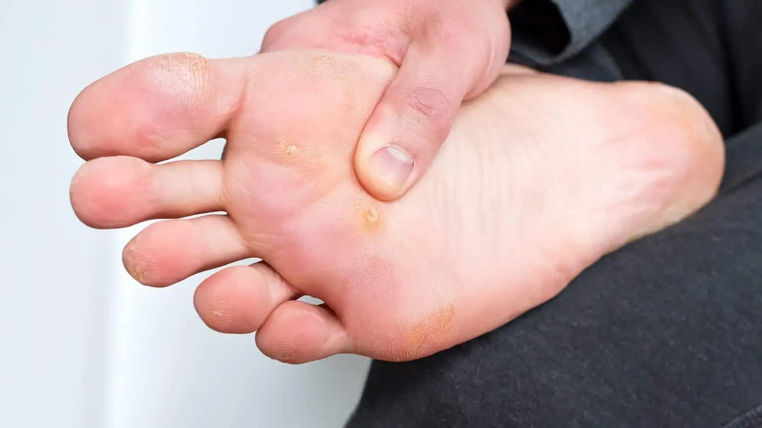 Kurie oko zmizlo bez vypaľovania a nohy mám hebké ako bábätko: Najrýchlejšia pomoc a funguje aj na bradavice!
