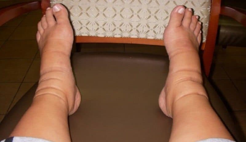 Liek na kŕčové žily, opuchy a bolesť nôh, ktorý je rokmi overený: Funguje lepšie, ako drahé prípravky!