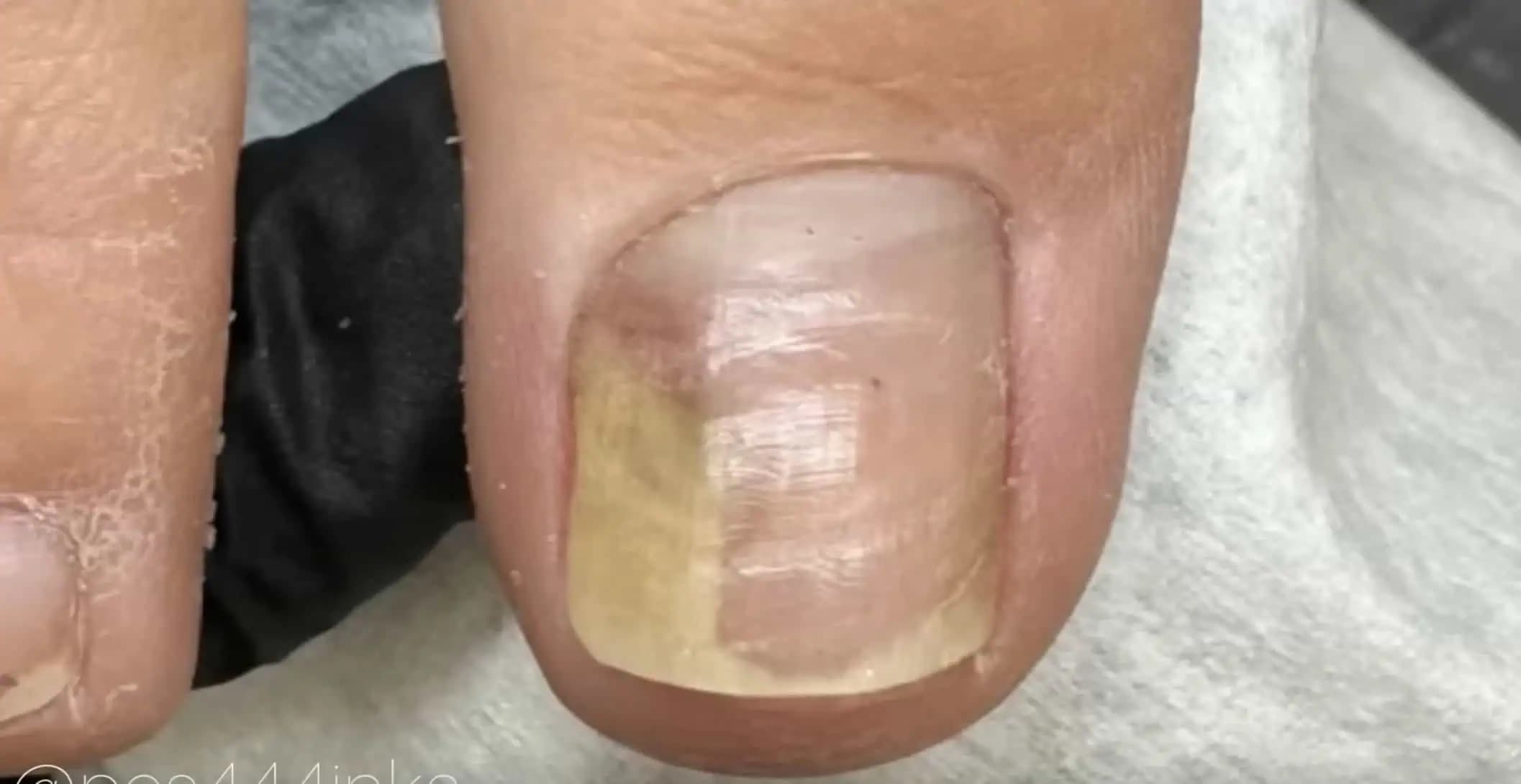 Vyzerá váš necht TAKTO? Hneď spravte túto vec a nepríjemný problém zmizne!