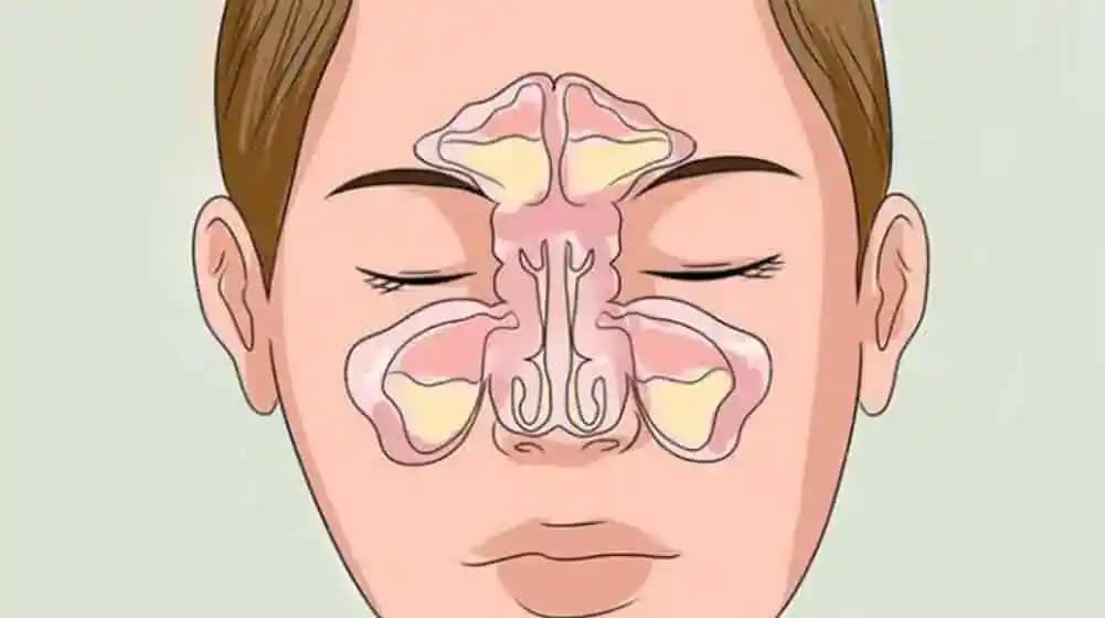 Najlepší tip, ako si uvoľniť UPCHATÝ NOS: Toto sú najlepší prírodní pomocníci!