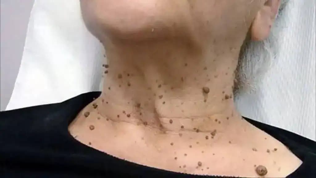 Trápia vás kožné výrastky a bradavice? Takto sa ich NAVŽDY zbavíte – jednoduché a bezpečné!