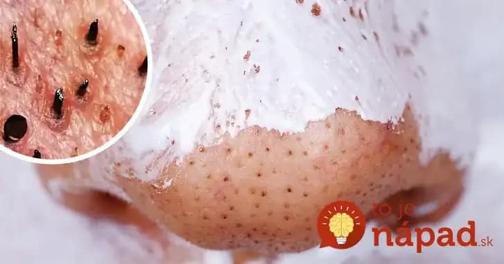 Zbohom kruhy pod očami, bodky a pigmentové škvrny: Na túto lacnú pomoc sa nechytajú ani drahé krémy, vaša tvár skrásnie!