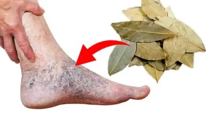 Mám 52 rokov a už ma konečne netrápia KŔČOVÉ ŽILY: Pomohol mi babkin zázračný domáci recept!