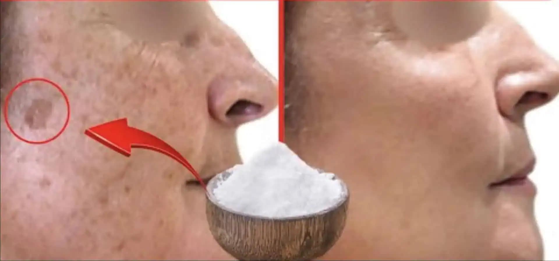 Jedlá SÓDA naozaj odstraňuje pigmentové ŠKVRNY! Kiežby som o tom vedela skôr!