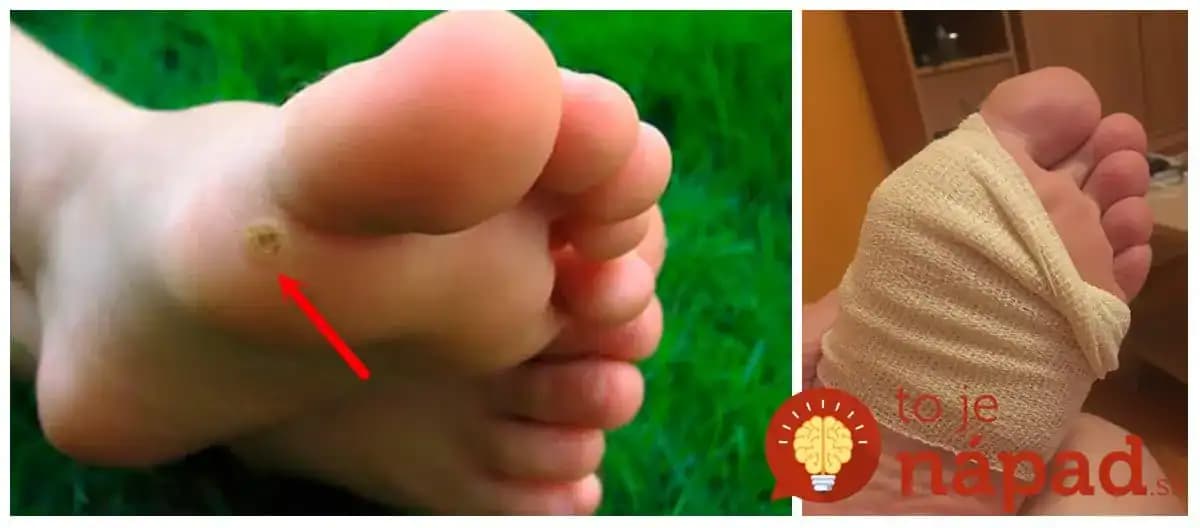 Bezbolestná metóda, ako sa zbaviť bradavice za 4 dni: Naučila ma to ešte moja starká, mám odskúšané už roky!