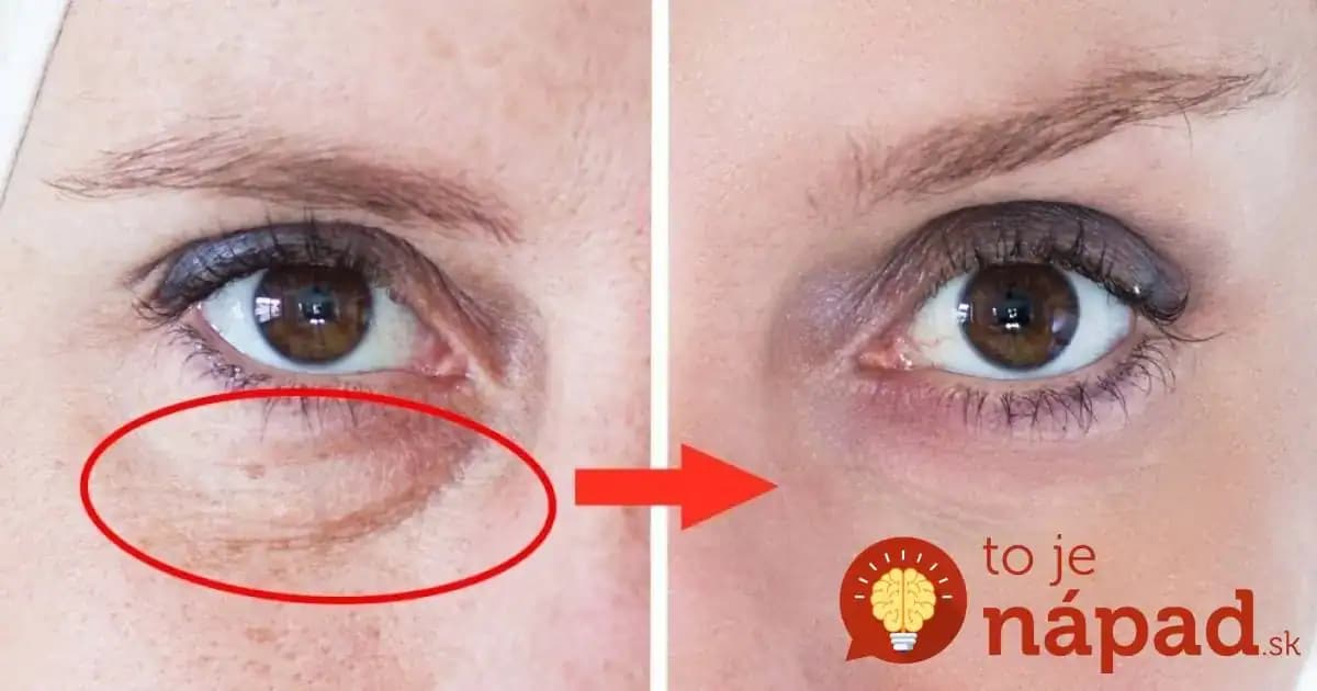 Kruhy pod očami vám pridajú aj 10 rokov: Toto je zaručený spôsob, ako ich odstrániť v rekordnom čase!