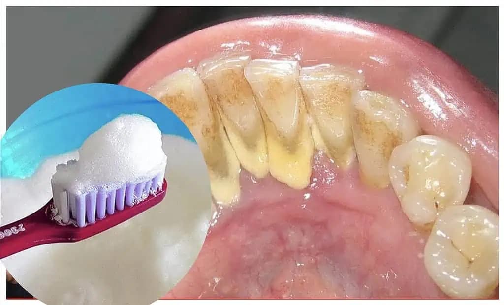 Trápia vás zubný kameň a tmavé škvrny na zuboch? Skúste tento PRÍRODNÝ recept, zmenu vidíte okamžite!