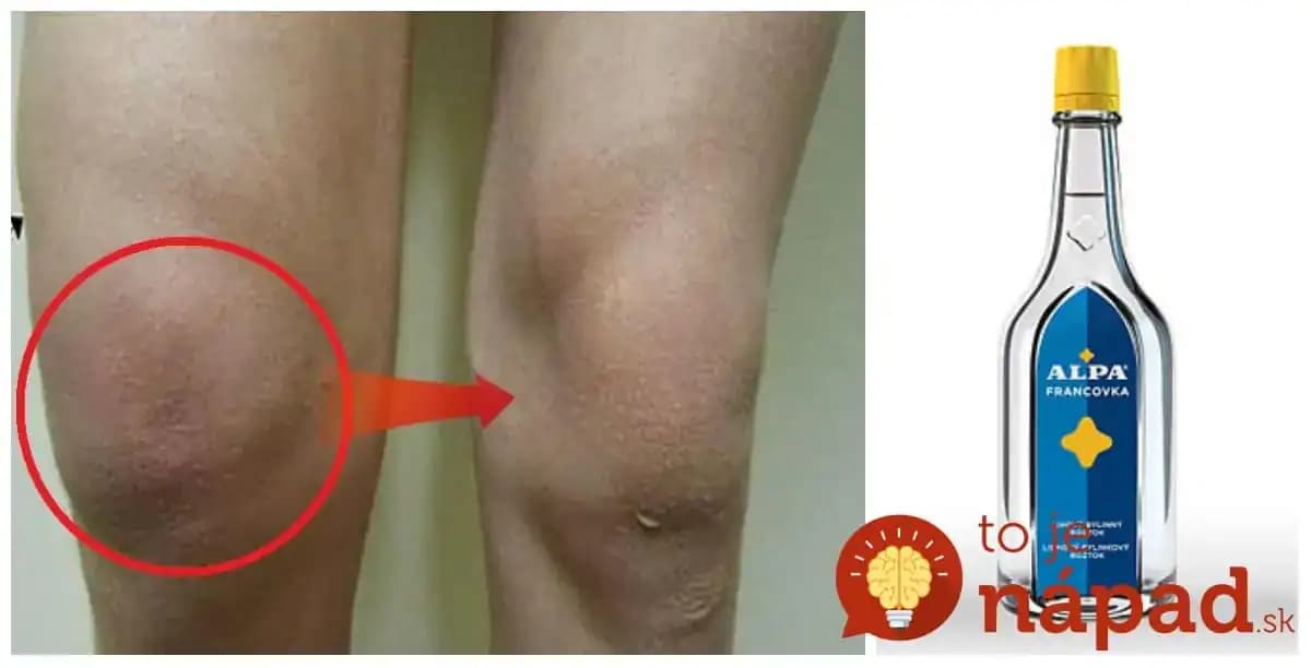 Záchrana pre reumatikov a tých, ktorých trápia bolestivé kĺby: Táto kombinácia by vám pravdepodobne nikdy nenapadla, no jej účinky sú ako zázrak!