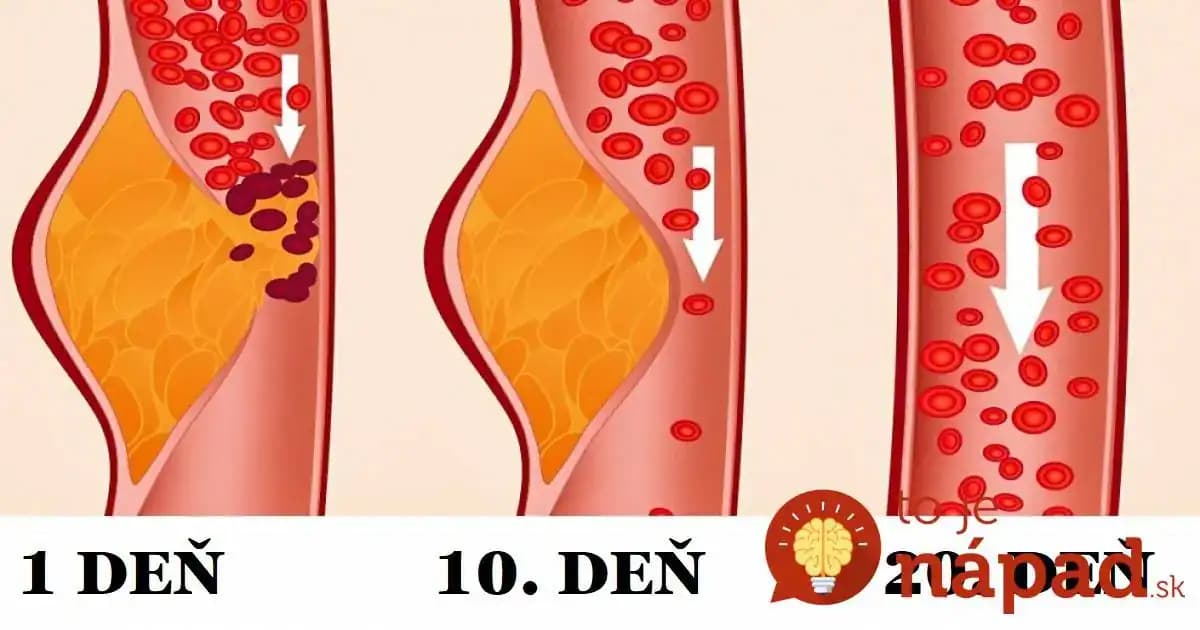 Jediná DIÉTA nad ktorou jasajú aj lekári: Odstráni nebezpečený tuk v cievach aj na bruchu!