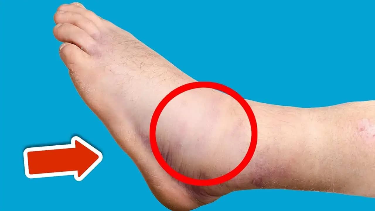 Tento jeden vitamín odstraňuje opuchy na chodidlách a nohách!