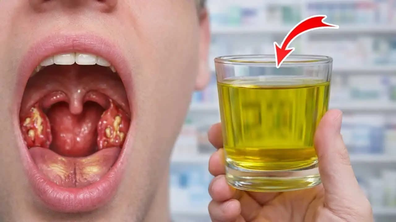 Dajte variť cibuľu s obyčajnými klinčekmi a  zabudnite, čo je ANGÍNA, bolesť hrdla a chrapot: Overený domáci recept!